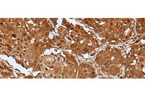 Immunohistochemistry of paraffin-embedded Human esophagus cancer tissue using UBA7 Polyclonal Antibody at dilution of 1:35(x200) (UBA7 antibody)