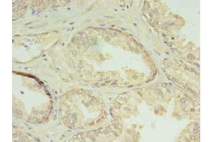Immunohistochemistry of paraffin-embedded human prostate cancer using ABIN7147537 at dilution of 1:100 (CHMP7 antibody  (AA 1-290))