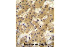 APOF antibody (Center) immunohistochemistry analysis in formalin fixed and paraffin embedded human hepatocarcinoma followed by peroxidase conjugation of the secondary antibody and DAB staining. (Apolipoprotein F antibody  (Middle Region))