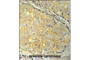 SDHAF1 Antibody (Center) (ABIN651585 and ABIN2840312) immunohistochemistry analysis in formalin fixed and paraffin embedded human prostate carcinoma followed by peroxidase conjugation of the secondary antibody and DAB staining. (SDHAF1 antibody  (AA 34-62))