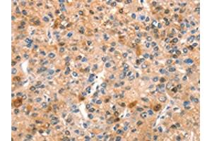 The image on the left is immunohistochemistry of paraffin-embedded Human liver cancer tissue using ABIN7192636(SPRN Antibody) at dilution 1/15, on the right is treated with synthetic peptide. (SPRN antibody)