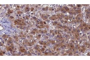 ABIN6276852 at 1/100 staining Human liver cancer tissue by IHC-P. (PTH1R antibody  (pThr1))