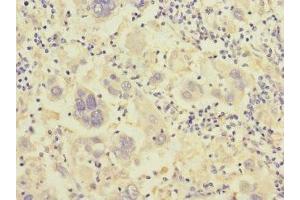 Immunohistochemistry of paraffin-embedded human liver cancer using ABIN7156498 at dilution of 1:100 (Integrin beta 7 antibody  (AA 1-140))