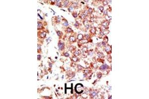 Formalin-fixed and paraffin-embedded human cancer tissue reacted with the primary antibody, which was peroxidase-conjugated to the secondary antibody, followed by DAB staining. (NEDD8 antibody  (N-Term))