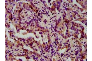 IHC image of ABIN7166187 diluted at 1:300 and staining in paraffin-embedded human lung cancer performed on a Leica BondTM system. (TIMELESS antibody  (AA 1004-1131))