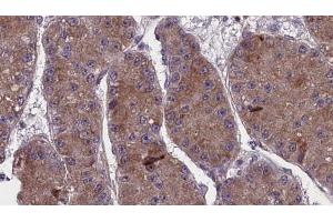 ABIN6272757 at 1/100 staining Human liver cancer tissue by IHC-P.
