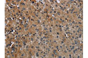 The image on the left is immunohistochemistry of paraffin-embedded Human liver cancer tissue using ABIN7129423(FAAH Antibody) at dilution 1/50, on the right is treated with fusion protein. (FAAH antibody)