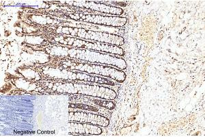 Immunohistochemical analysis of paraffin-embedded human colon cancer tissue. (EIF4A1 antibody)