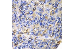 Immunohistochemistry of paraffin-embedded human liver cancer using CES1 antibody. (CES1 antibody)