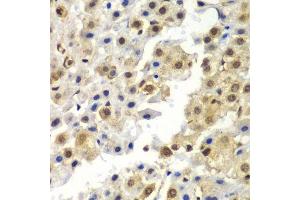 Immunohistochemistry of paraffin-embedded human liver cancer using SYNCRIP antibody. (SYNCRIP antibody  (AA 1-200))