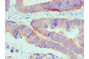 Immunohistochemical of paraffin-embedded Human Colon cancer tissue using ABIN7145293 at dilution of 1:200 (BCL2L1 antibody)