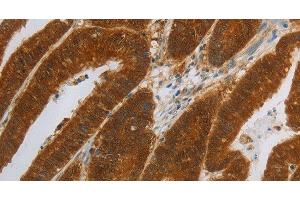 Immunohistochemistry of paraffin-embedded Human colon cancer using NIT2 Polyclonal Antibody at dilution of 1:40 (NIT2 antibody)