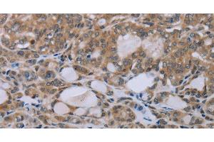 Immunohistochemistry of paraffin-embedded Human thyroid cancer tissue using NAIP Polyclonal Antibody at dilution 1:30 (NAIP antibody)