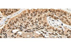 Immunohistochemistry of paraffin-embedded Human esophagus cancer tissue using CCDC112 Polyclonal Antibody at dilution of 1:45(x200) (CCDC112 antibody)