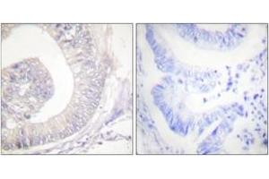 Immunohistochemistry analysis of paraffin-embedded human colon carcinoma, using HSL (Phospho-Ser855/554) Antibody. (LIPE antibody  (pSer855))
