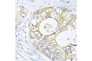 Immunohistochemistry of paraffin-embedded human colon carcinoma using GNAI3 antibody at dilution of 1:100 (40x lens).