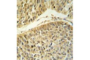 Formalin fixed paraffin embedded lung carcinoma stained with RERE Antibody (N-term) followed by peroxidase conjugation of the secondary antibody and DAB staining. (RERE antibody  (N-Term))