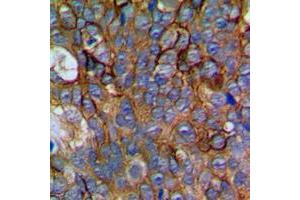 Immunohistochemical analysis of NCALD staining in human prostate cancer formalin fixed paraffin embedded tissue section. (NCALD antibody  (Center))