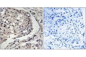 Immunohistochemistry analysis of paraffin-embedded human breast carcinoma tissue, using MLK1/2 (Ab-312/266) Antibody. (MLK1/2 antibody  (AA 281-330))