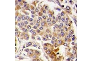 IHC analysis of FFPE human breast carcinoma tissue stained with AMPK antibody (PRKAA1 antibody  (AA 474-502))