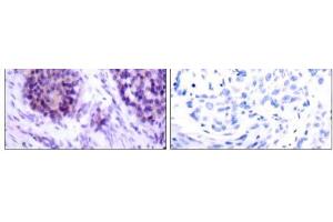 Immunohistochemical analysis of paraffin-embedded human breast carcinoma tissue using BCL-XL (phospho-Ser62) antibody (E011066). (BCL2L1 antibody  (pSer62))