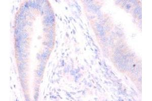 Immunohistochemistry of paraffin-embedded human colon cancer using ABIN7171243 at dilution of 1:100 (Syntaxin 6 antibody  (AA 5-234))