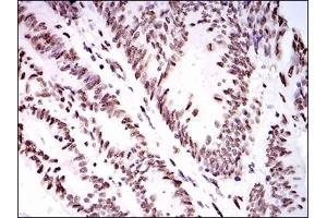 Immunohistochemical analysis of paraffin-embedded human colon cancer tissues using HNRNPU mouse mAb with DAB staining.