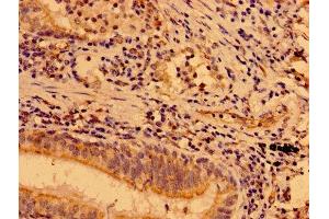 IHC image of ABIN7160061 diluted at 1:400 and staining in paraffin-embedded human lung cancer performed on a Leica BondTM system. (MAP3K9 antibody  (AA 864-1098))