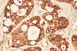 Anti-Src Picoband antibody,  IHC(P): Human Intestinal Cancer Tissue (Src antibody  (AA 2-368))