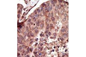 Formalin-fixed and paraffin-embedded human cancer tissue reacted with the primary antibody, which was peroxidase-conjugated to the secondary antibody, followed by AEC staining. (PKLR antibody  (C-Term))