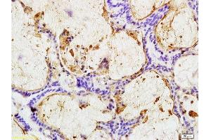 Formalin-fixed and paraffin embedded human colon carcinoma labeled with Anti-CEA(B5) Monoclonal Antibody, Unconjugated (bsm-1624M) at 1:200 followed by conjugation to the secondary antibody and DAB staining