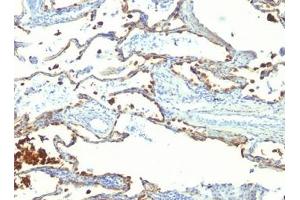 FFPE human lung carcinoma tested with MFG-E8 antibody (SPM291) (MFGE8 antibody)