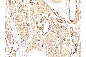 Formalin-fixed, paraffin-embedded human Leiomyosarcoma stained with Smooth Muscle Actin Mouse Monoclonal Antibody (1A4).