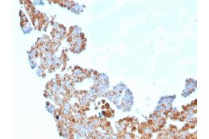 Formalin-fixed, paraffin-embedded human Breast Carcinoma stained with CDC34 Mouse Monoclonal Antibody (CPTC-CDC34-2). (CDC34 antibody)