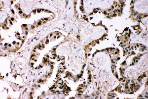 Anti- GST3/GST pi Picoband antibody, IHC(P) IHC(P): Human Lung Cancer Tissue (GSTP1 antibody  (AA 2-210))