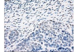 Immunohistochemical staining of paraffin-embedded Adenocarcinoma of colon tissue using anti-PPP5Cmouse monoclonal antibody.