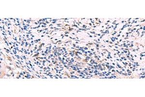 Immunohistochemistry of paraffin-embedded Human cervical cancer tissue using GKAP1 Polyclonal Antibody at dilution of 1:95(x200) (GKAP1 antibody)