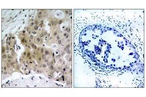 Immunohistochemical analysis of paraffin-embedded human breast carcinoma tissue, using V (VEGFR2/CD309 antibody  (pTyr1175))