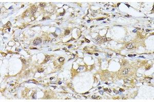 Immunohistochemistry of paraffin-embedded Human liver cancer using PSMA7 Polyclonal Antibody at dilution of 1:100 (40x lens). (PSMA7 antibody)