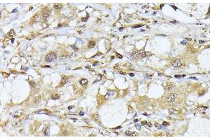 Immunohistochemistry of paraffin-embedded Human liver cancer using PSMA7 Polyclonal Antibody at dilution of 1:100 (40x lens).