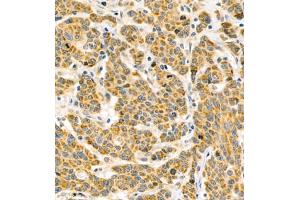 Immunohistochemistry of paraffin embedded human colon cancer using BPTF (ABIN7073234) at dilution of 1:500 (400x lens) (BPTF antibody)