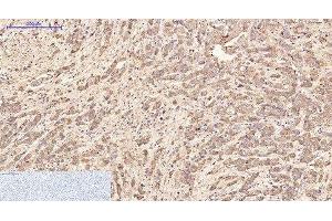 Immunohistochemistry of paraffin-embedded Human breast cancer tissue using AFP Monoclonal Antibody at dilution of 1:200. (alpha Fetoprotein antibody)