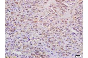 Formalin-fixed and paraffin embedded human cervical carcinoma labeled with Anti-WAPL Polyclonal Antibody, Unconjugated (ABIN872457) at 1:200 followed by conjugation to the secondary antibody