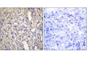 Immunohistochemistry analysis of paraffin-embedded human liver carcinoma tissue, using LAMB1 Antibody. (Laminin beta 1 antibody  (AA 1721-1770))