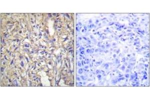 Immunohistochemistry analysis of paraffin-embedded human liver carcinoma tissue, using LAMB1 Antibody.