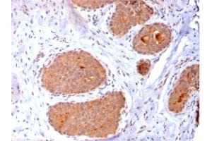 Formalin-fixed, paraffin-embedded human Breast Carcinoma stained with HSP60 Mouse Monoclonal Antibody (CPTC-HSPD1-1).