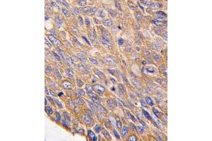 Formalin-fixed and paraffin-embedded human lung carcinoma tissue reacted with TOB2 antibody (N-term) (ABIN390219 and ABIN2840699) , which was peroxidase-conjugated to the secondary antibody, followed by DAB staining. (TOB2 antibody  (N-Term))