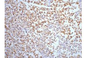 Immunohistochemistry (IHC) staining of Human small cell carcinoma of lung tissue, diluted at 1:200. (ENO2/NSE antibody)
