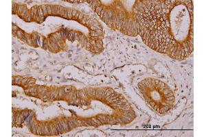 Immunoperoxidase of monoclonal antibody to NDRG4 on formalin-fixed paraffin-embedded human colon adenocarcinoma. (NDRG4 antibody  (AA 1-339))