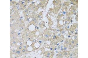 Immunohistochemistry of paraffin-embedded Human liver damage using CHMP1B Polyclonal Antibody at dilution of 1:100 (40x lens).